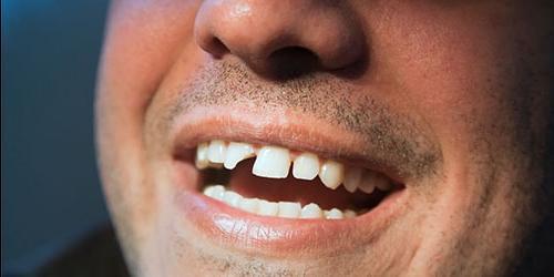 O que sonho com a ruptura dos meus dentes?
 185