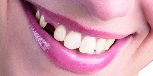 O que sonho com a ruptura dos meus dentes?