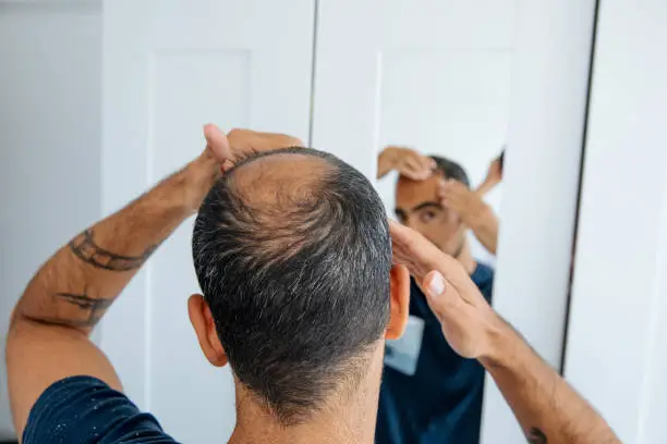 Interpretação dos Sonhos: O Significado de Sonhar com Ser Careca