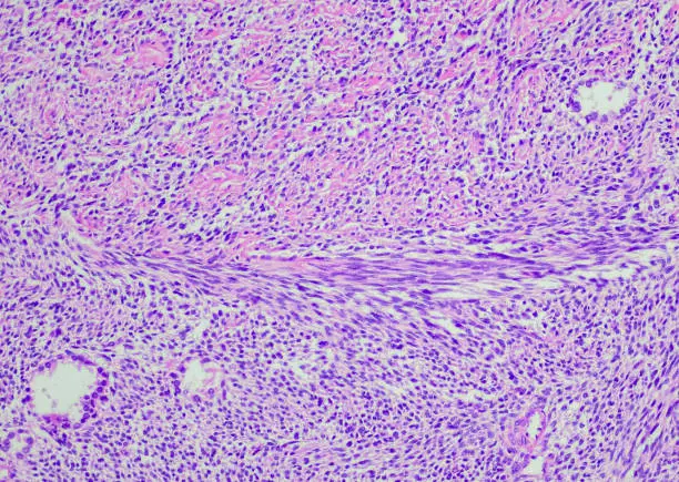 Interpretação dos Sonhos sobre Sarcoma: Uma Análise Oracular